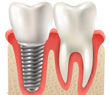 Dental Implantes Ocean Dental Burnaby